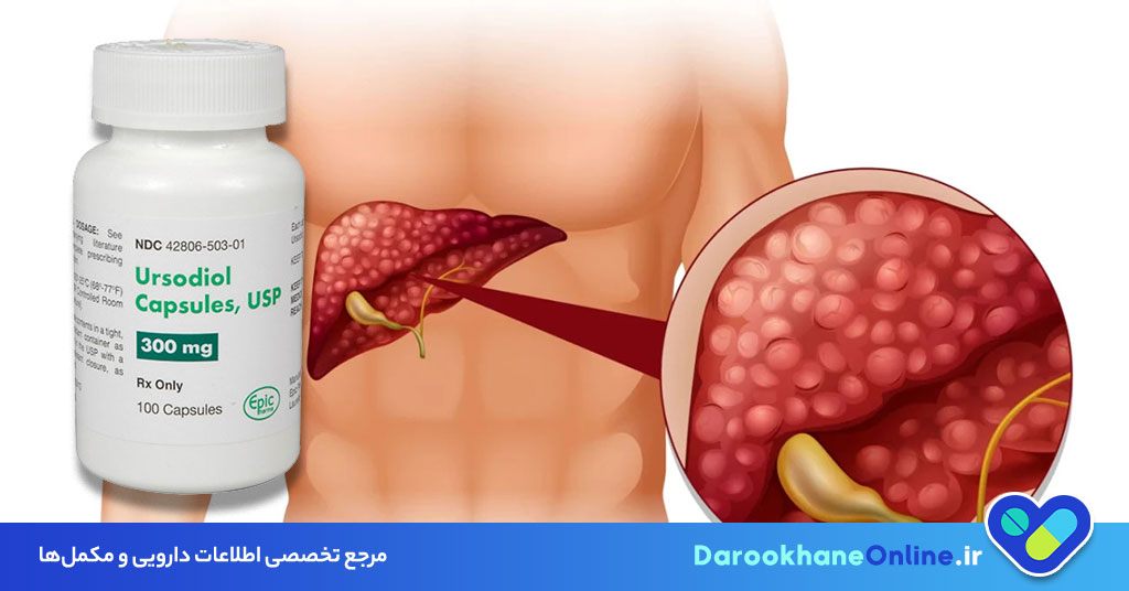 قرص اورسودیول (Ursodiol)؛ نحوه مصرف، موارد کاربرد و عوارض داروی موثر در درمان سنگ کیسه صفرا