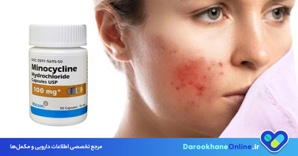 قرص مینوسیکلین چیست و برای چه مواردی تجویز می‌شود؟ موارد مصرف، نحوه مصرف و عوارض minocycline