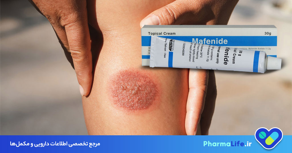 مفنامید (Mafenide) چیست؟ کاربرد، نحوه مصرف و عوارض پماد مفنامید در درمان سوختگی