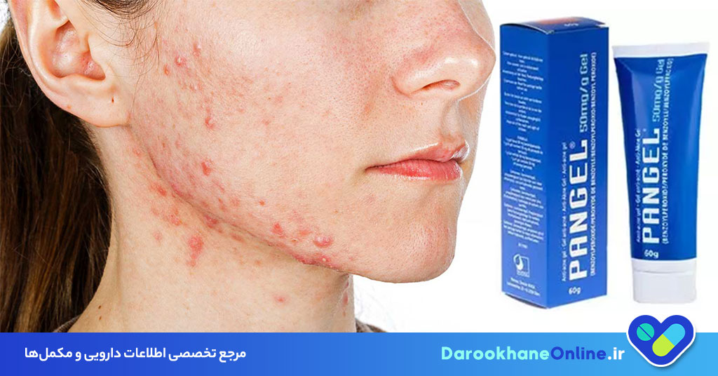 کرم بنزوئیل پروکساید برای درمان آکنه | اثرات، کاربرد، عوارض و نکات مصرف