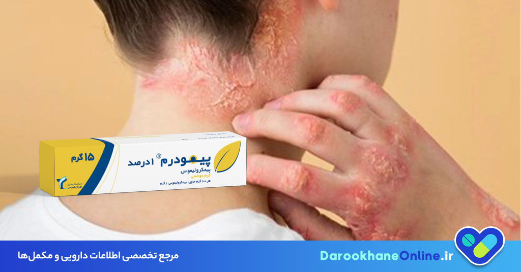 کرم پیمکرولیموس؛ درمان جدید و موثر اگزما و درماتیت آتوپیک | موارد مصرف، عوارض و نکات مهم