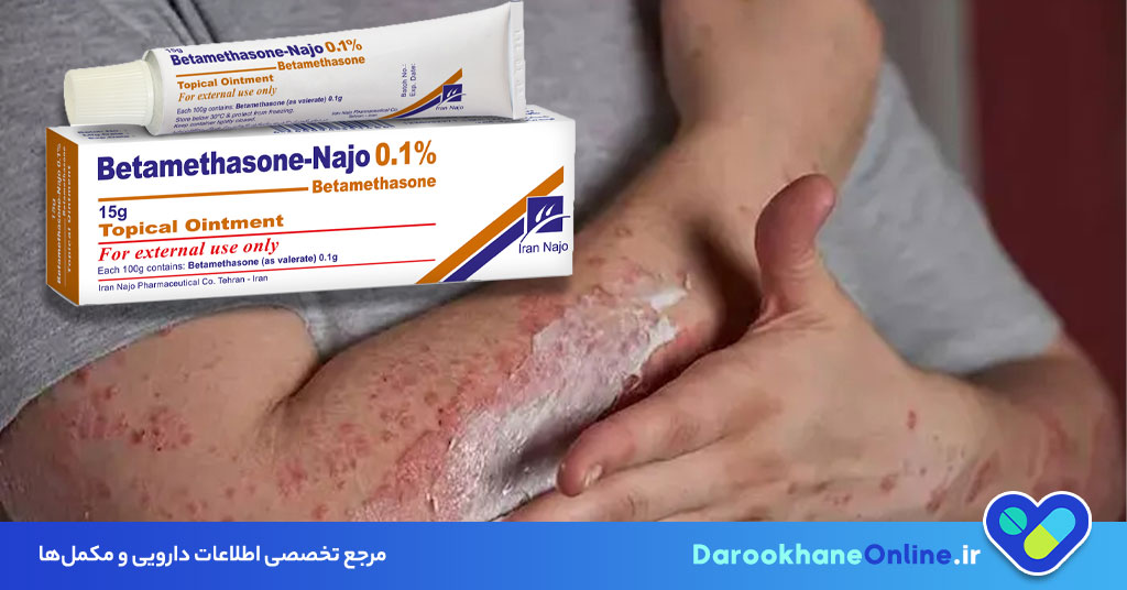 پماد بتامتازون چیست و چه کاربردی دارد؟ موارد مصرف، نحوه استفاده و عوارض Betamethasone