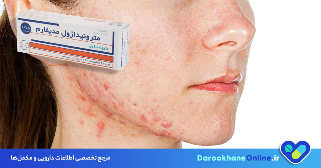 ژل مترونیدازول چیست و چه کاربردی در درمان مشکلات پوستی و روزاسه دارد؟ (بررسی علمی، نحوه مصرف و عوارض) 27 ژل مترونیدازول
